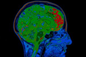 Funding needed to deal with dementia ‘tsunami’